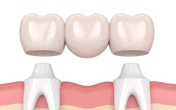 Dental Kopruler
