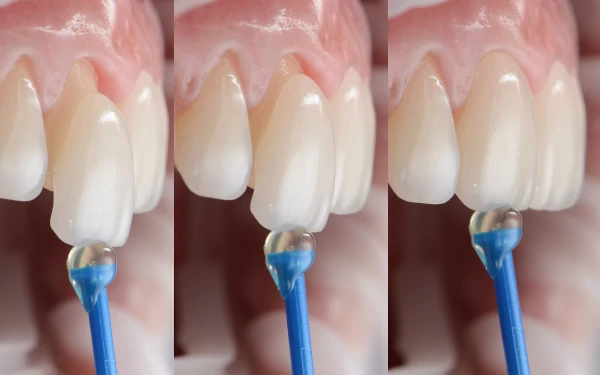 Dental Veneers
