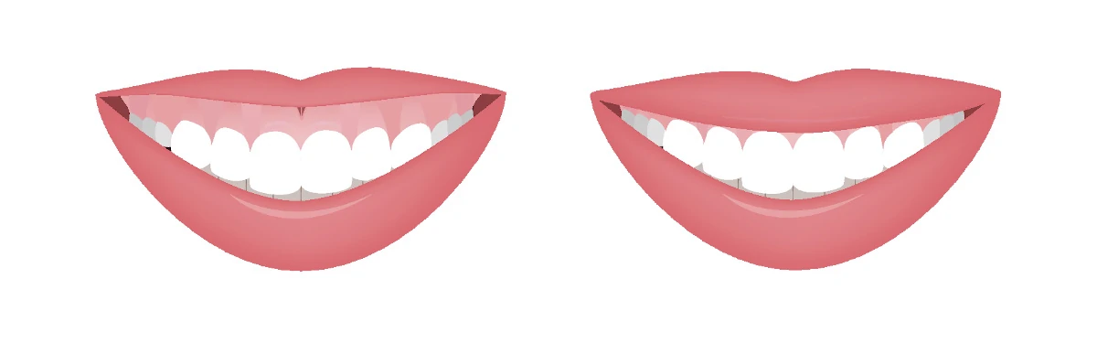Gummy Smile