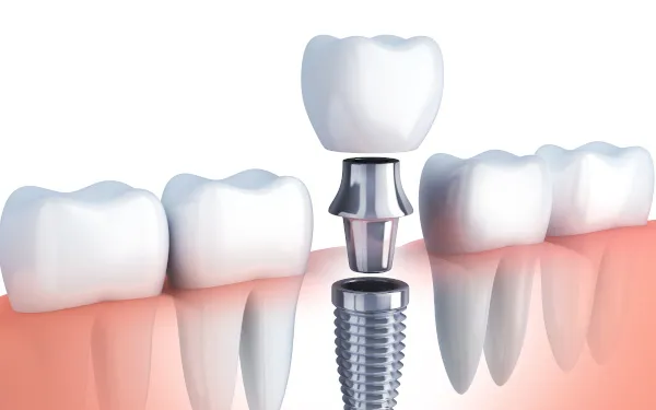 Dental Implant
