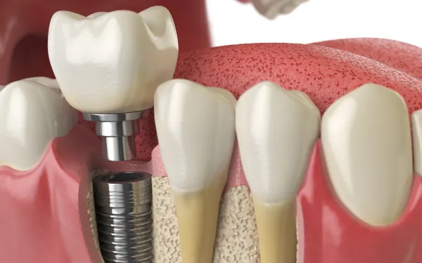 Dental Implant