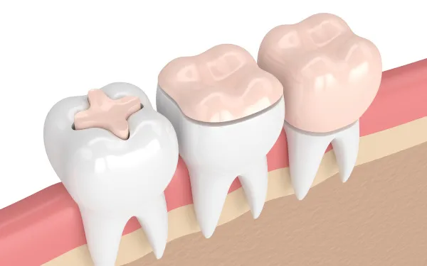 Dental Kopruler