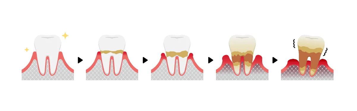 Periodontal Diseases